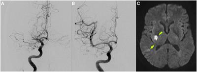 Repeated Endovascular Treatment of Early Recurrent Proximal Middle Cerebral Artery Occlusion: Case Report and Brief Review of the Literature